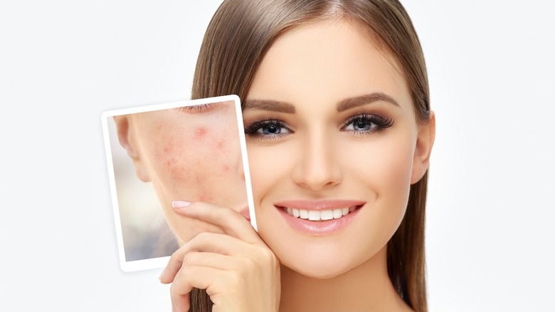 Girl with a photo of acne