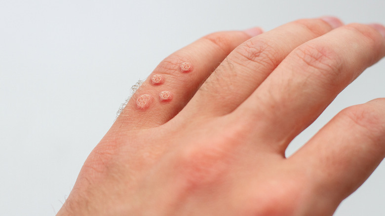 Hand with warts on it